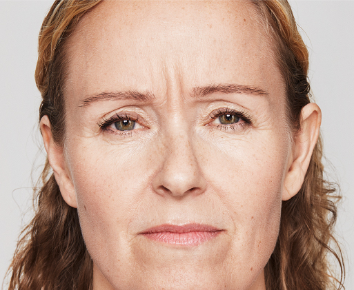Woman with 11 lines_Before BOTOX Injectables