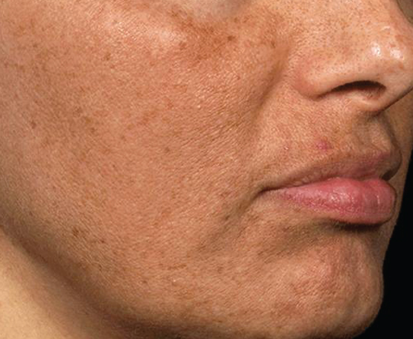 Fraxel® Fractional Skin Resurfacing Treatment_AFTER TREATMENT IMAGE